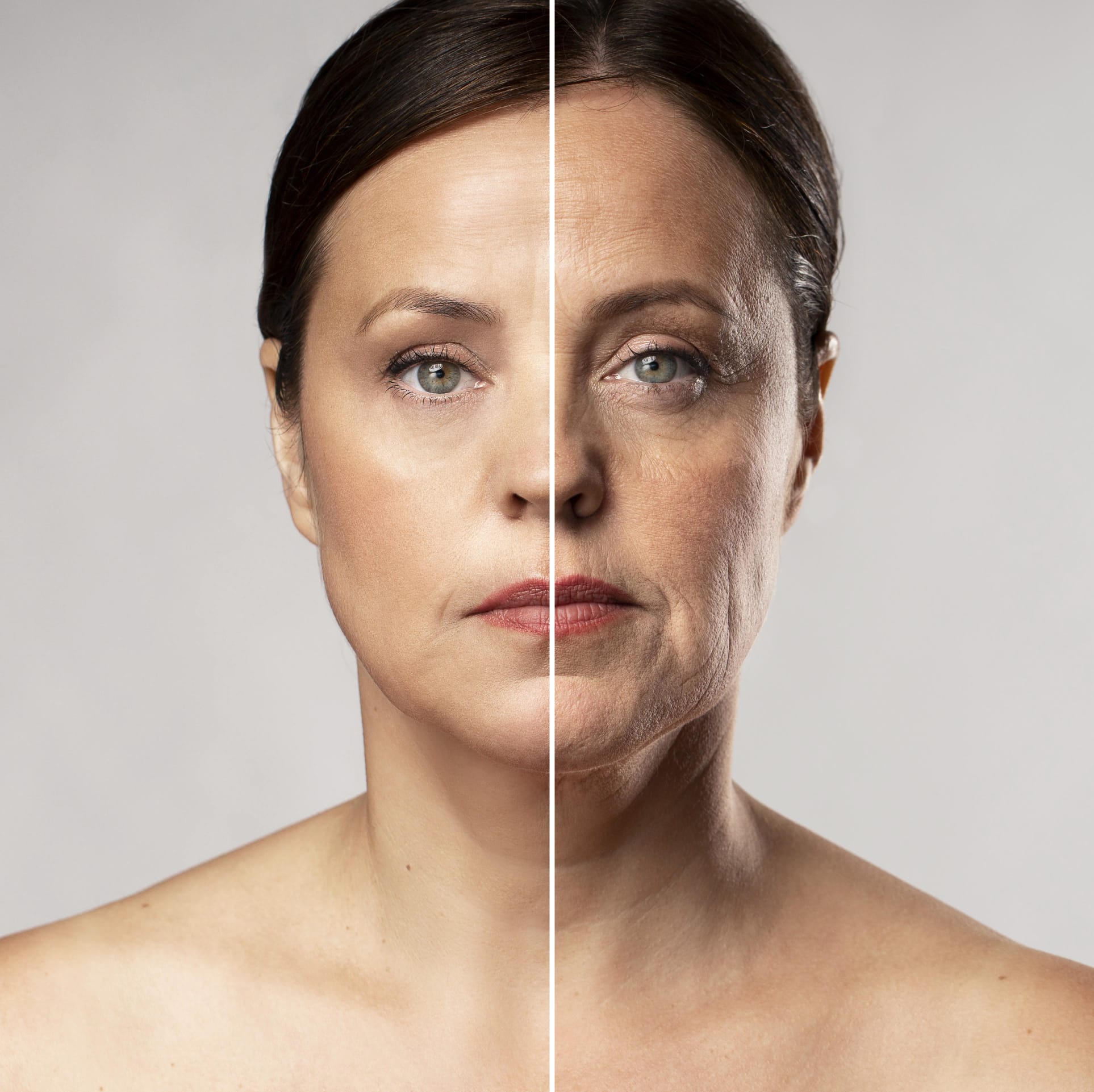 Botox en Biobella