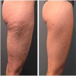 Antes y después con Endospheres corporal 1