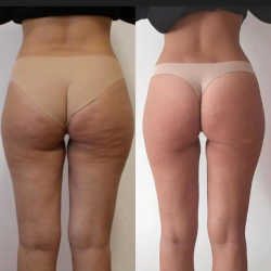 Antes y después con Endospheres corporal 2