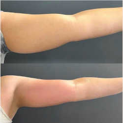 Antes y después con Endospheres corporal 3