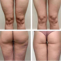 Antes y después con Endospheres corporal 4