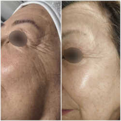 Antes y después de tratamiento con Endospheres en Biobella 1