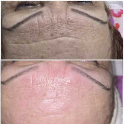 Antes y después de tratamiento con Endospheres en Biobella 3