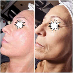 Antes y después de tratamiento con Endospheres en Biobella 4