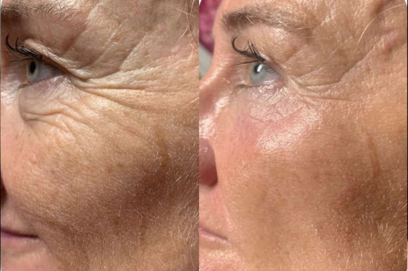 Tratamiento facial Endospheres Biobella